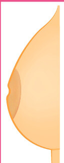 Bauchdeckenstrffung