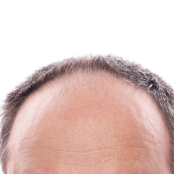 Haartransplantation