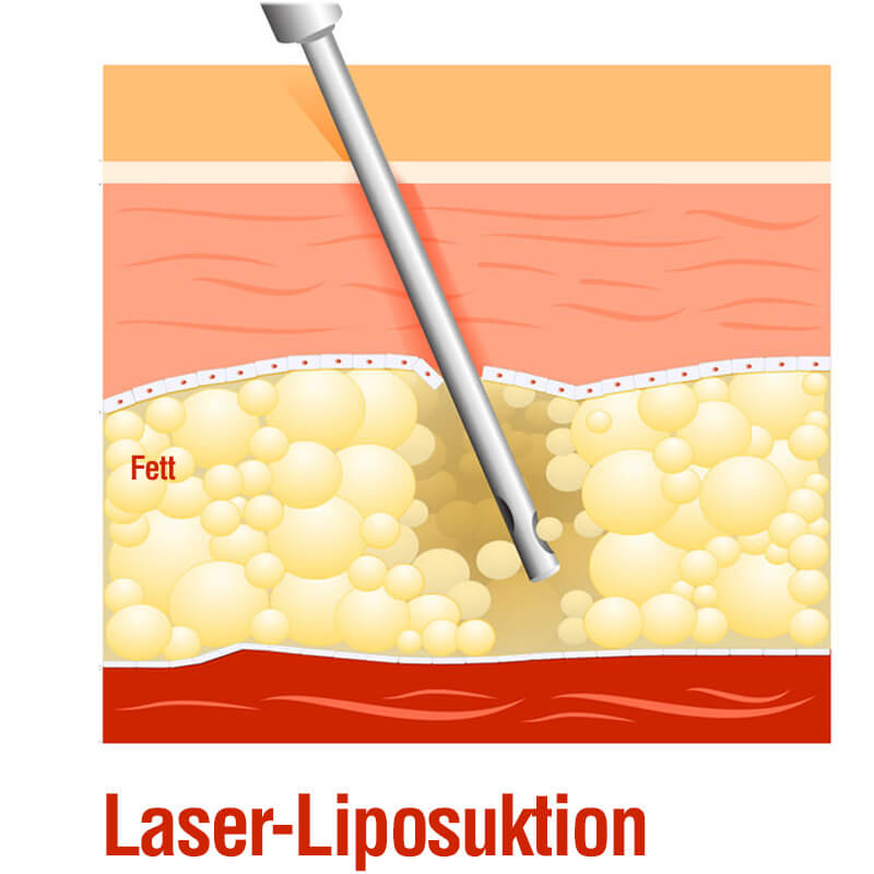 Grafische Darstellung einer Laser-Liposuktion zur gezielten Fettabsaugung